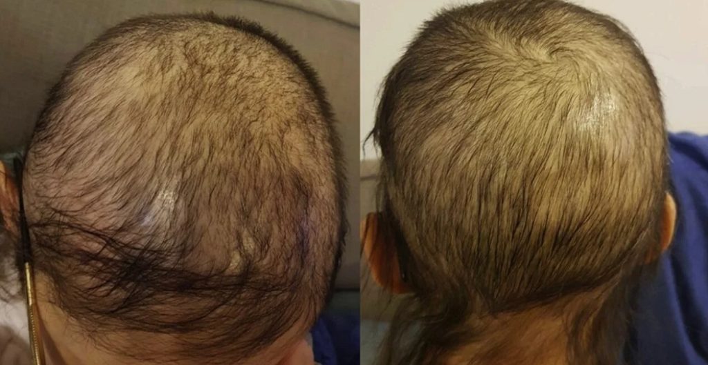 U.S. authorities have recalled a popular hair loss treatment serum after discovering that its packaging is not child-resistant, which could lead to serious injury or death if the liquid is ingested, according to the Daily Mail.