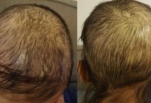U.S. authorities have recalled a popular hair loss treatment serum after discovering that its packaging is not child-resistant, which could lead to serious injury or death if the liquid is ingested, according to the Daily Mail.