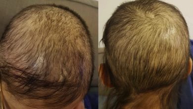 U.S. authorities have recalled a popular hair loss treatment serum after discovering that its packaging is not child-resistant, which could lead to serious injury or death if the liquid is ingested, according to the Daily Mail.