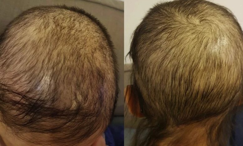U.S. authorities have recalled a popular hair loss treatment serum after discovering that its packaging is not child-resistant, which could lead to serious injury or death if the liquid is ingested, according to the Daily Mail.
